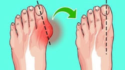 شانه یخ‌زده چیست؟ + فیلم