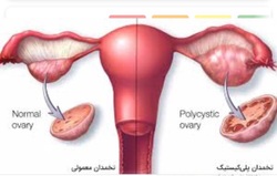 اصلاح سبک زندگی راهکاری برای درمان تنبلی تخمدان + فیلم