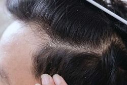 روش از بین بردن شوره‌های سر + فیلم