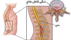 شباهت و تفاوت دیسک کمر با تنگی کانال نخاعی + فیلم