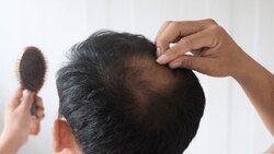 آیا پسوریازیس درمان قطعی دارد؟ + فیلم