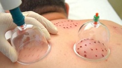 حجامت آلرژی برای رفع حساسیت بهاره + فیلم