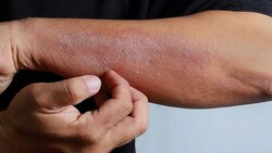 راه‌های جلوگیری از بیماری شپش سر + فیلم
