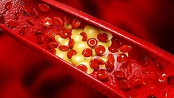 علائم سکته قلبی را بشناسید + فیلم