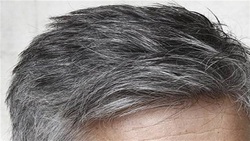 علت سنگ ساز شدن کلیه‌ها چیست؟ + فیلم