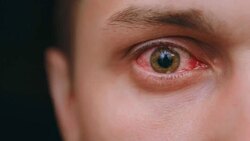 عوارض ابتلا به آلرژی در کودکان + فیلم
