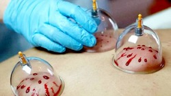 کدام نقطه از بدن بیشترین فایده در حجامت را دارد؟ + فیلم