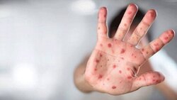 آیا آبله میمون، همه گیر می‌شود؟ + فیلم