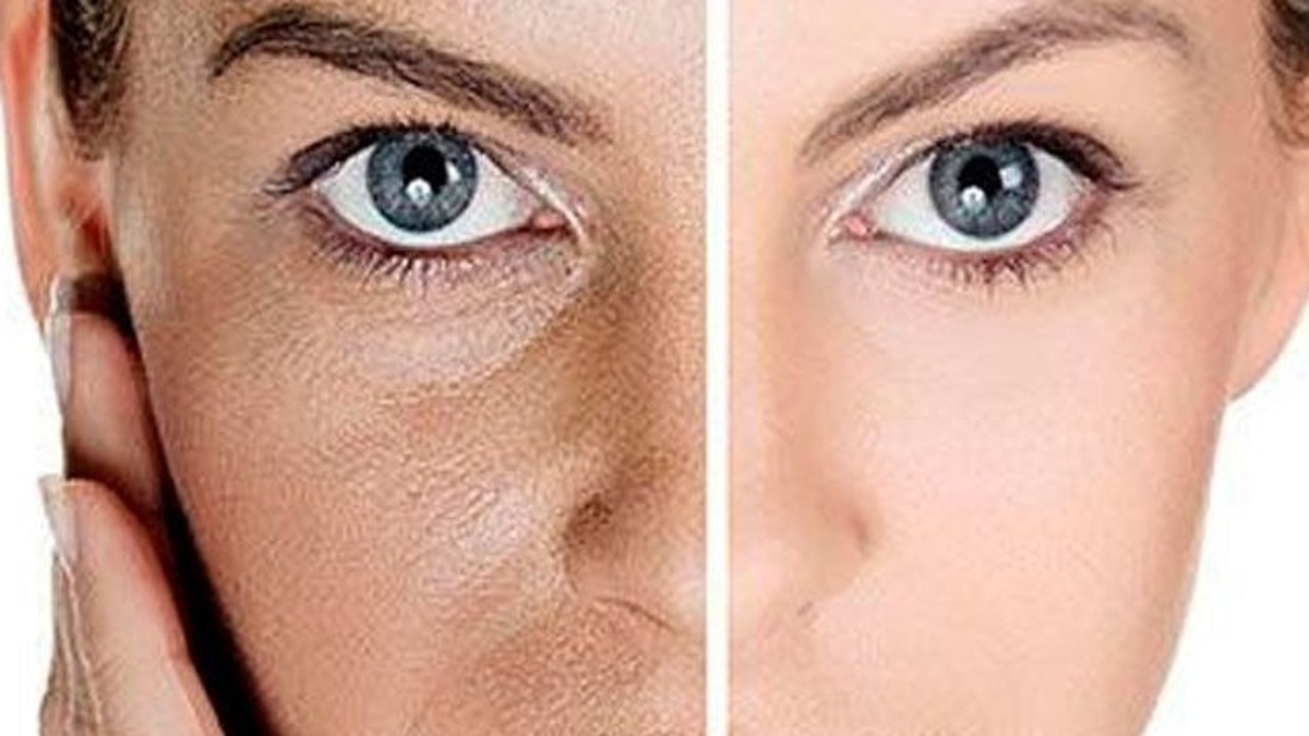علائم ابتلا به کیست کلیه چیست؟ + فیلم